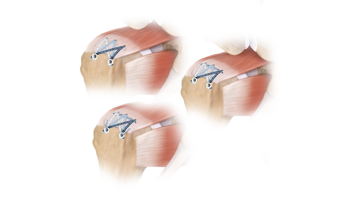 Arthrex - FiberTak SpeedBridge Implant System Includes three